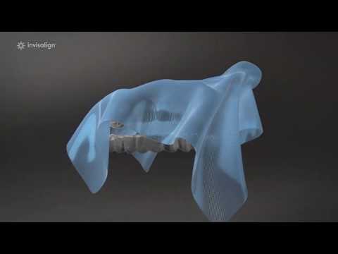 Invisalign - Forestside Dental Practice