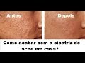 COMO TRATAR CICATRIZ DE ACNE EM CASA - GUIA COMPLETO