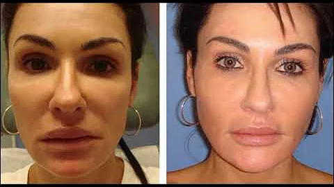 NON SURGICAL REMOVAL OF SILICONE FROM LIPS