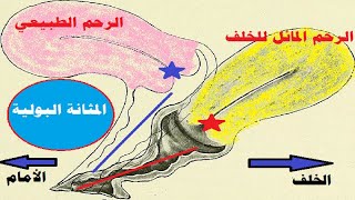 الرحم المقلوب و الحمل ( الرحم المائل ) هل يسبب تأخر الحمل و تاخر الإنجاب