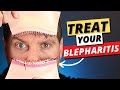 Blepharitis: Top 3 Treatments For Blepharitis Removal At Home