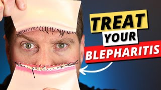 Blepharitis: Top 3 Treatments For Blepharitis Removal At Home