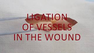 Ligation of vessels in the wound