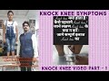 knock knees problem Part – 1 | Extra care physiotherapy center Lucknow [Hindi]