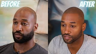 Raul Gets SCALP MICROPIGMENTATION in New York