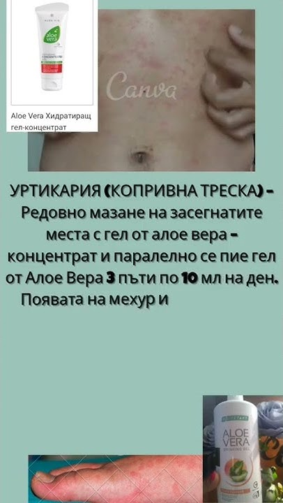 #УРТИКАРИЯ (КОПРИВНА ТРЕСКА) – Редовно мазане на засегнатите места с ...