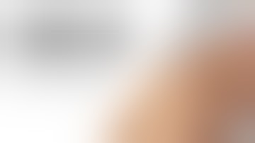 Hammer toe surgery performed in office with no scars | Minimally Invasive | Dr. Nicholas Campitelli