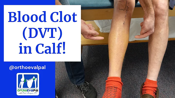 Blood Clot (DVT) in  the Calf! Actual Patient Presentation - DayDayNews