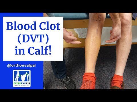 Blood Clot (Dvt) In The Calf! Actual Patient Presentation - Youtube