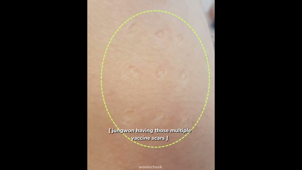 Watch jungwon having those multiple vaccine scars #enhypen #jungwon on YouTube Watch jungwon having those multiple vaccine scars #enhypen #jungwon on YouTube