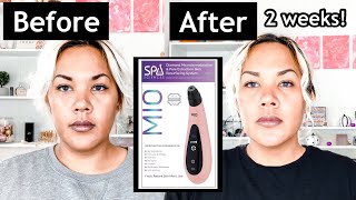 Microdermabrasion Before And After | Done At HOME