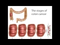 Colorectal cancer