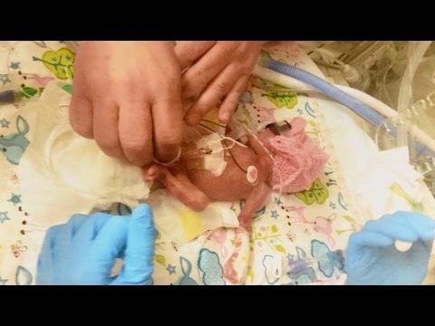 Baby Born at 24-Weeks With Feet The Size Of Pennies Beats All Odds