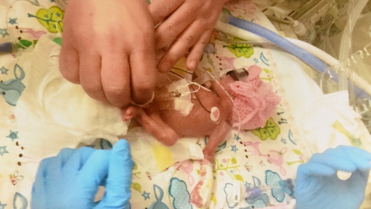 Baby Born At 24 Weeks With Feet The Size Of Pennies Beats All Odds Youtube