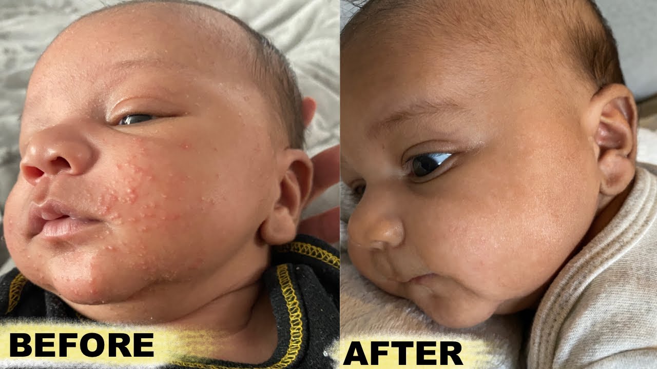 Does Tubby Todd Help With Baby Acne? 