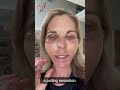 My advanced facelift recovery day by day  real stories by real patients 2022