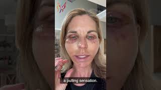 My Advanced Facelift Recovery Day by Day  Real Stories By Real Patients 2022