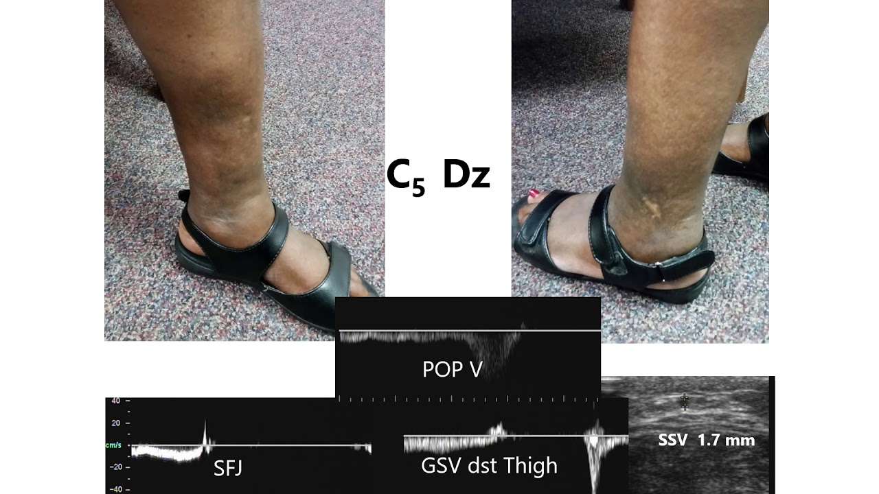 Popliteal Vein Compression - Virtual Vascular Lab Channel