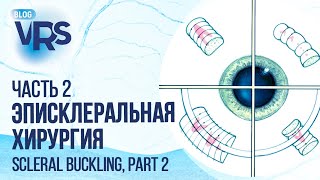 видео: Эписклеральное пломбирование, часть 2 | Scleral buckling, part 2 картинка: Эписклеральное пломбирование, часть 2 | Scleral buckling, part 2
