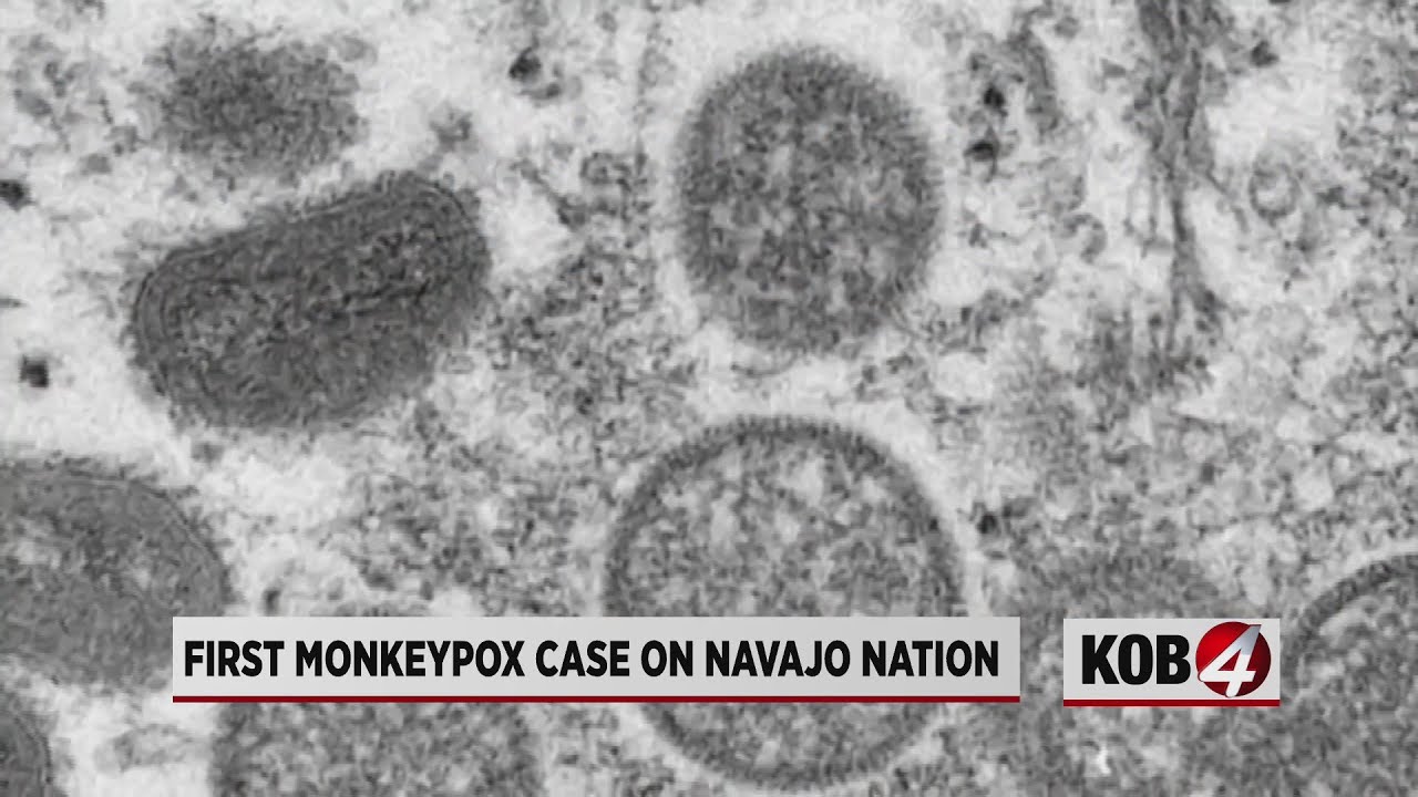 First Monkeypox case confirmed on Navajo Nation - YouTube