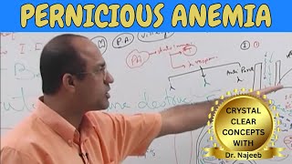 Pernicious Anemia | Diagnostic Features | Pathophysiology
