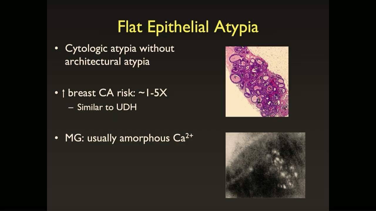 053 Managing Atypia, LCIS and Other High risk Lesions Freemedbooks.com