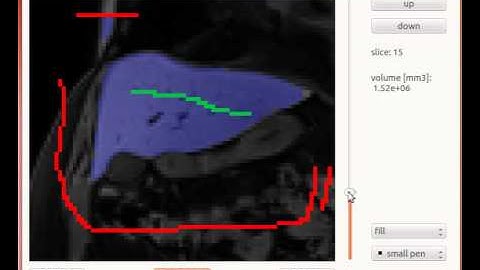 Liver extraction from MRI data via Graph-Cut