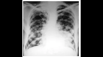 ¿Se ve metástasis pulmonar en la radiografía?