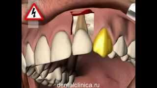 Лечение зубов красивая улыбка виниры коронки протезирование имплантация приятные цены(Клиника European Clinic of Aesthetic Dentistry in Budapest 