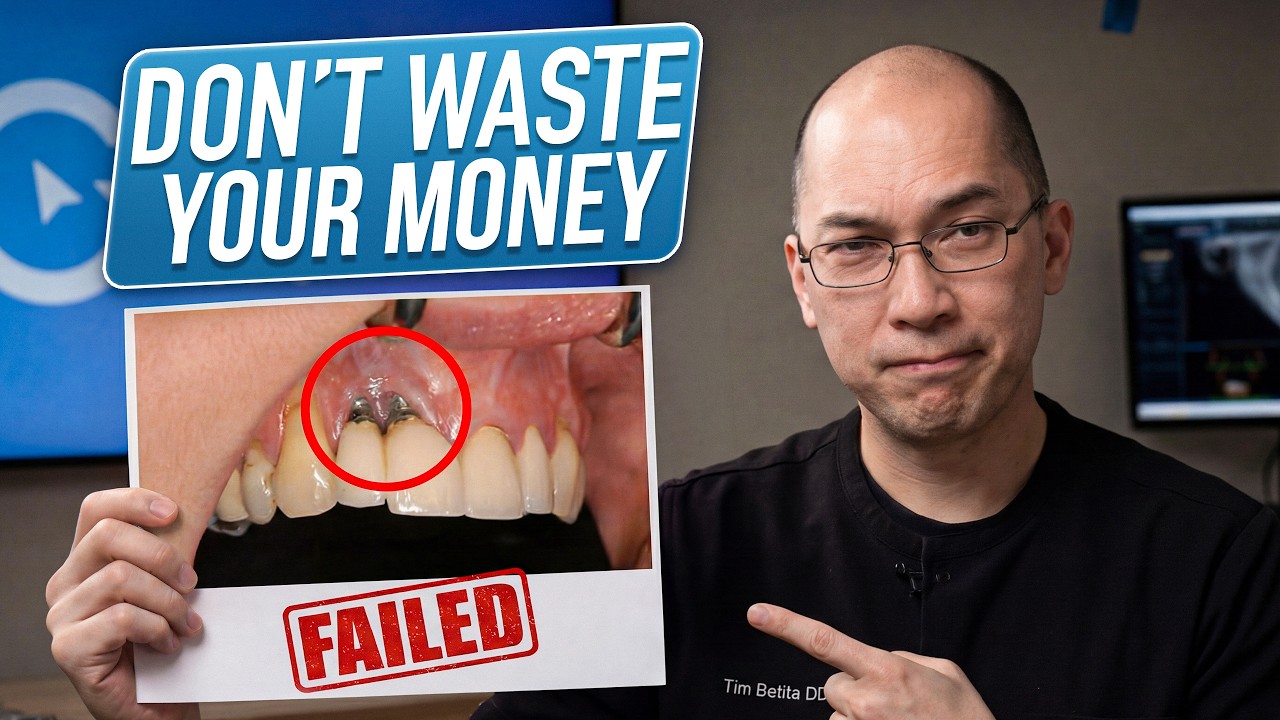 Why Dental Implants Fail (And How to Avoid It)