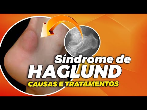 Vídeo: Síndrome Do Calcanhar: Sintomas, Causas, Tratamento