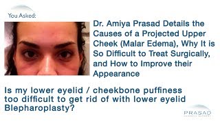 The Causes of Projected Upper Cheeks (Malar Edema) and How to Improve this Difficult Issue