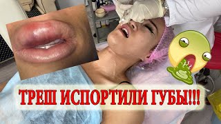 ТРЕШ ОБЗОР КОСМЕТОЛОГ ИСПОРТИЛ МНЕ ГУБЫ/ Я В ШОКЕ