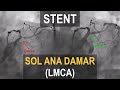 STENT | Sol Ana Damar (LMCA) Vakası