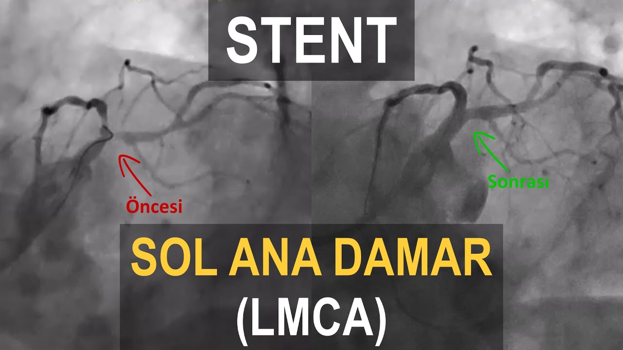 Stent or Bypass?