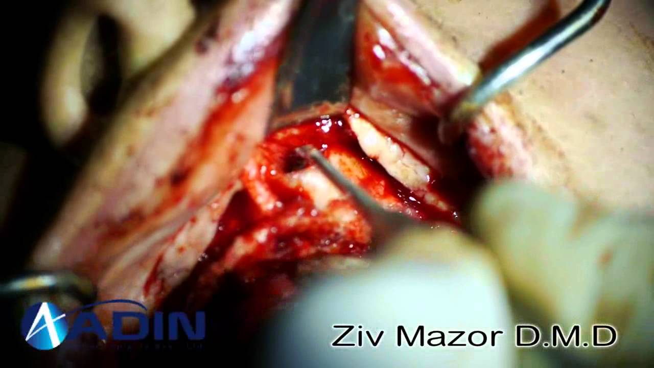 Maxillary Bone Reconstruction - YouTube