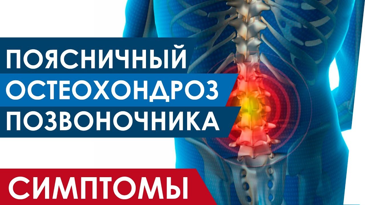 Поясничный остеохондроз позвоночника симптомы - YouTube