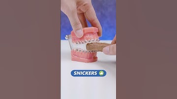 Các loại socola niềng răng không nên ăn?| Lạc Việt Intech Niềng Răng #shorts