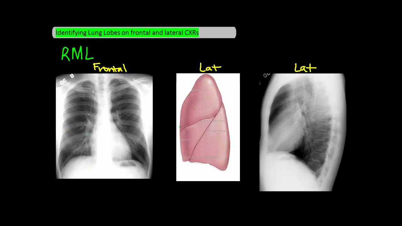 Identifying Lung Lobes on Frontal and Lateral Chest X-Rays