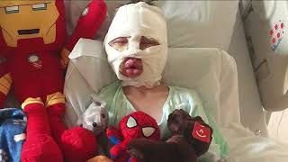 6-year-old Connecticut boy brutally burned, mother says he was bullied