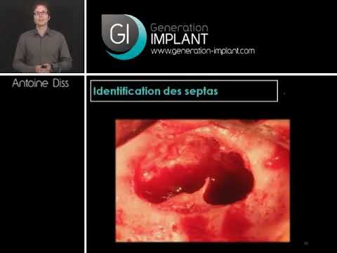 Vidéo: Anatomie, Fonction Et Fonction Du Sinus Maxillaire - Cartes Corporelles