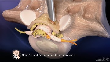 Interlaminar Approach for Endoscopic Discectomy Procedures