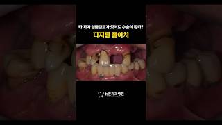[부산전체임플란트] 타 치과 임플란트가 있어도 수술이 된다 ? #shorts