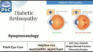 Symptoms of Diabetic Retinopathy