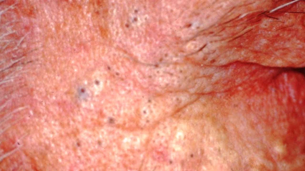 Pimple Popping Cyst And Acne Compilation Dermatology Videos Cysts