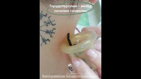 Гирудотерапия - метод лечения пиявками