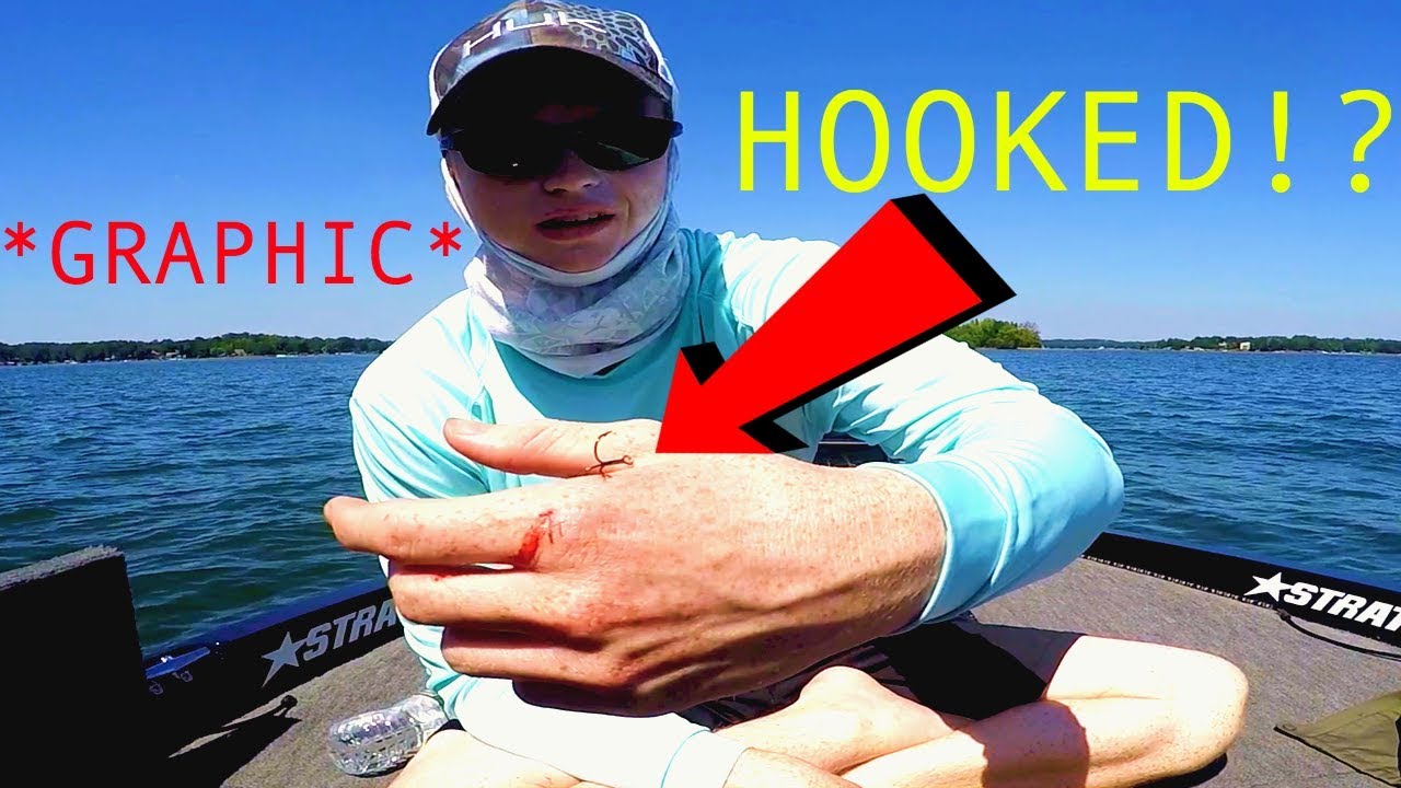HOOK STUCK IN MY HAND! How to Remove a Treble Hook YouTube