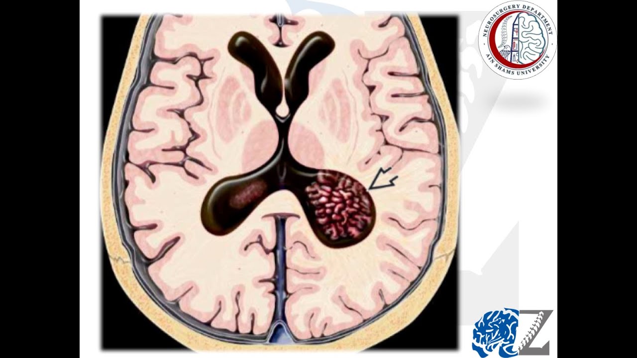 Brain Tumours (19): Choroid Plexus Tumours أورام الضفيرة المشيمية بالمخ