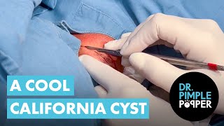 A Cool California Cyst screenshot 4