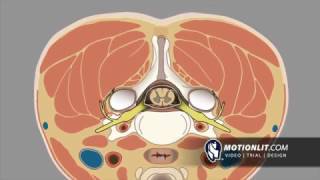 Epidural Injection Procedure | 3D Animation
